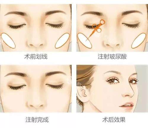 深圳安美聚光整形怎么样？6D轮廓+体雕塑形实例直击！彭喜医生主刀速度快，立体美轻松拿捏