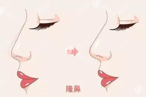 成都周维做鼻子怎么样?鼻部整形特别拿手|病例多且好看自然|临床口碑好|初鼻和修复鼻找他
