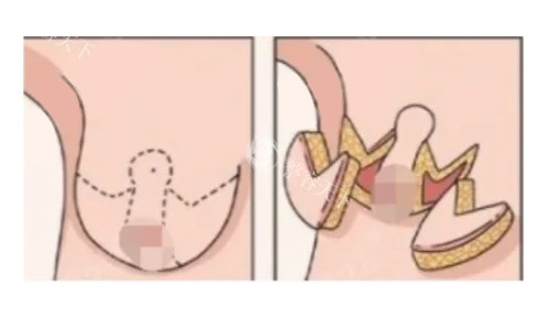 倒T法(标准乳房缩减术)展示 倒T法(标准乳房缩减术)展示