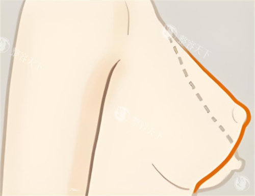 乳房下垂矫正轮廓对比 乳房下垂矫正轮廓对比