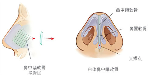 硅胶隆鼻容易歪吗？手术操作规范、术后护理得当就可以避免这个问题
