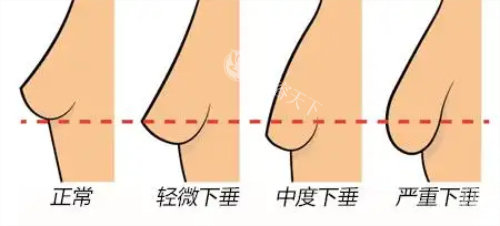胸部下垂程度图片 胸部下垂程度图片
