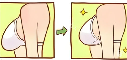 乳房下垂内衣穿着对比 乳房下垂内衣穿着对比
