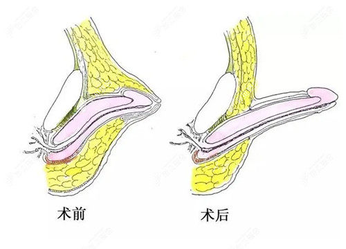 男性私密整形阴茎增长手术示意图 男性私密整形阴茎增长手术示意图