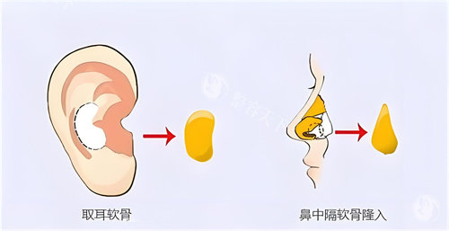 隆鼻耳软骨 隆鼻耳软骨