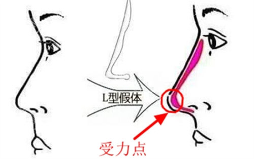 如何拯救失败隆鼻？闫海廷高难度隆鼻失败修复实例分析：3D定制技术+自体软骨移植真实实例解析