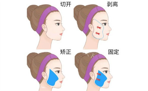 广州余东文拉皮手术做得怎么样？从爱美者的口碑中是一位做拉皮技术娴熟的医生！