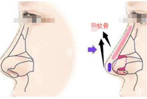南昌韩美美容医院吴涛怎么样？适合网红款还是妈生款？5位患者同项目不同诉求术后评价反馈公布！