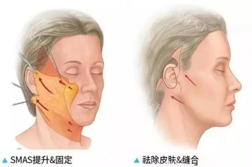 魏广运拉皮手术真实病例大公开！从面部松弛到紧致轮廓的真实蜕变，看50+患者术后年轻10岁的前后对比