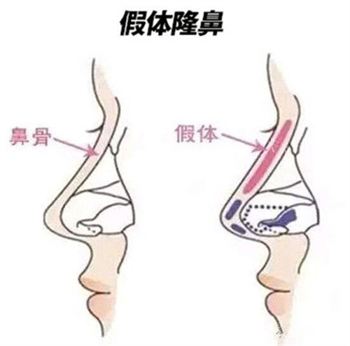 硅胶隆鼻和膨体隆鼻哪个好？从多个角度对比这两种材料