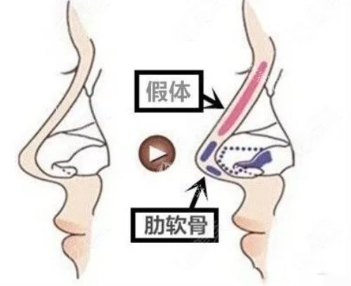 王谊做鼻子技术怎么样?术前方案制定细致，术后没有排异，我觉得很赞!