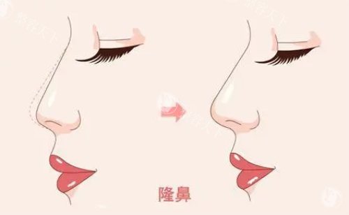 武汉同济医学院医院吴辉做鼻子怎么样，在鼻整形及修复领域技术十分成熟有多年的经验！