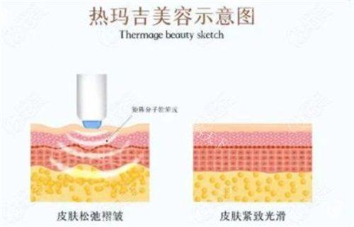 面部松弛怎么办？热玛吉、超声、注射、埋线提升、拉皮这些提升项目值得一试！