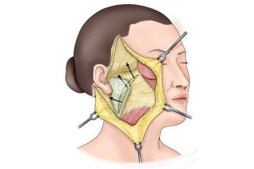 北京加减美整形谁体验过技术好不好？真实用户口碑+术前术后对比图，做完拉皮后自然吗？