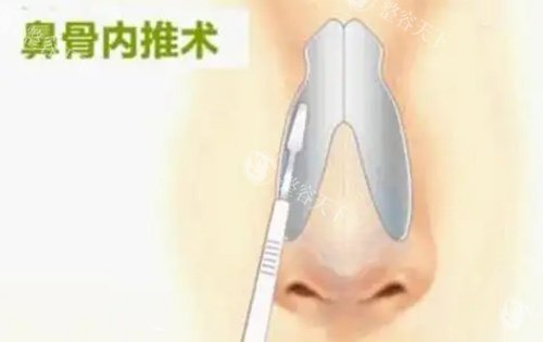 广州鼻骨内推多少钱？基础版8000+搭鼻翼缩小15000+搭驼峰鼻矫正30000+修复50000+
