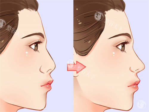 南昌佳美美容医院隆鼻怎么样？技术好吗？老牌医生面诊+多个隆鼻方式可选+网友评价曝光！