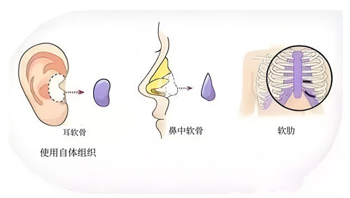 杨万忠医生做鼻子自然吗？术后结果与改善周期分析！可缩短7-10天！