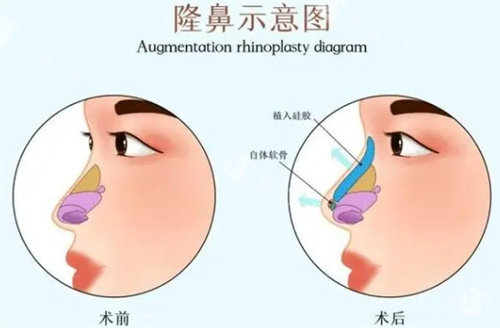 南宁芯玥整容医院隆鼻好不好？医院鼻整形特色/医生介绍/价格/口碑多方面解析