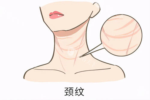 颈纹卡通示意图 颈纹卡通示意图