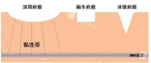 不同的疤痕种类 不同的疤痕种类