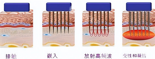 黄金微针操作过程 黄金微针操作过程