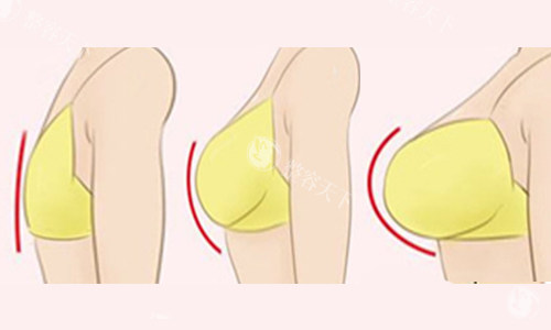 杭州美莱整形医院隆胸多少钱？假体隆胸35000起/脂肪丰胸28000起手感自然都能选！