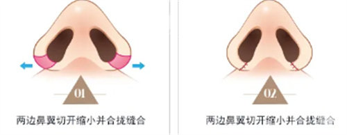 重庆周柯做鼻子自然吗？真实实例图与术后手感评价分析！