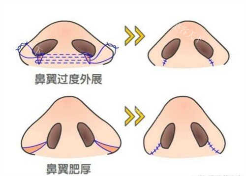重庆周柯做鼻子自然吗？真实实例图与术后手感评价分析！