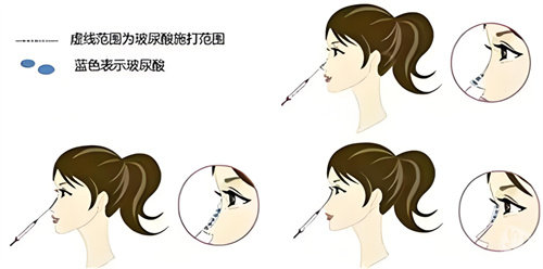 南方潮湿地区做膨体隆鼻感染率更高吗？深度解析气候、材料与感染风险