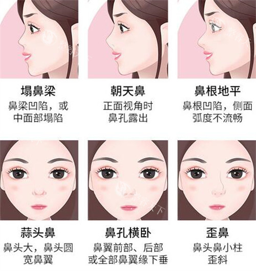 重庆鼻修复选周柯还是汪志强？铜雀台医生技术风格对比分析！