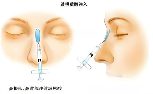 悦龄塑打鼻子多久定型？85%的求美者可在15-21天获得理想结果！