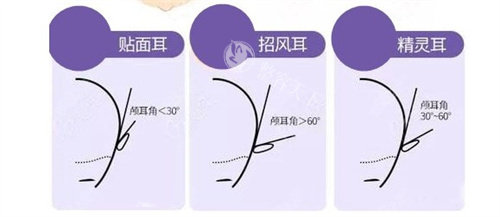 贴面耳招风耳精灵耳区别 贴面耳招风耳精灵耳区别