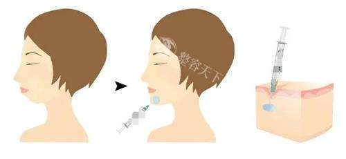 3D打印PEEK下巴多少钱？总价通常在5万-15万元之间