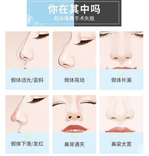 重庆鼻修复选周柯还是汪志强？铜雀台医生技术风格对比分析！