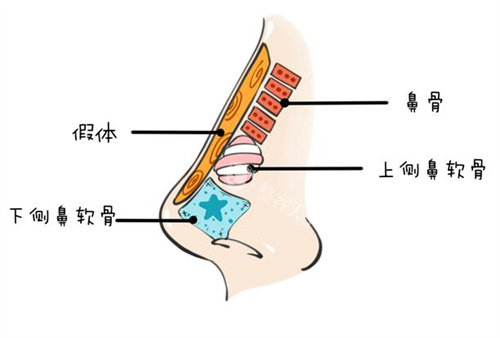 悦龄塑打鼻子多久定型？85%的求美者可在15-21天获得理想结果！
