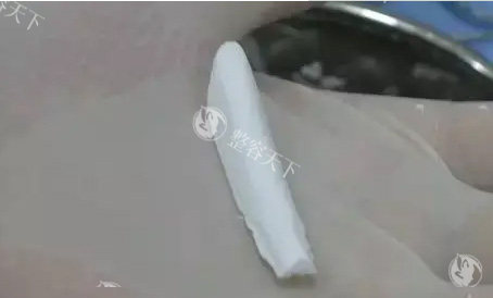 杭州王光建做的鼻子怎么样？王医生隆鼻技术很出色在行业内都备受认可！
