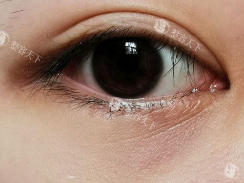 眼周状态差？肤莱美胶原蛋白注射成效到底咋样？有效填充眼周凹陷/改善细纹！