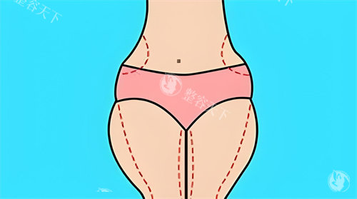 腿部吸脂手术吸脂部位动画图 腿部吸脂手术吸脂部位动画图
