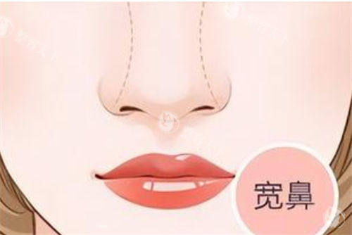 杭州艺星医疗美容医院隆鼻怎么样？国内隆鼻有名的医院之一！硅胶隆鼻|肋软骨隆鼻两种方式常被推荐！