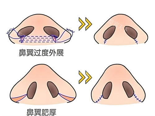 鼻翼缩小手术怎么做？内切口、外切法及联合切除步骤解析
