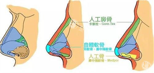杭州杨礼医生做鼻子怎么样？杨医生专注鼻整形及修复10余年，做鼻子看重自然美感！