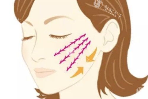 7D聚拉提适合什么部位？额头与眉部、眼周区域、下颌与颈部等