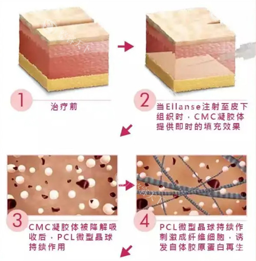 濡白天使和少女针填充哪个好？想要脸部“高智感”去打眉弓用哪个品牌好？