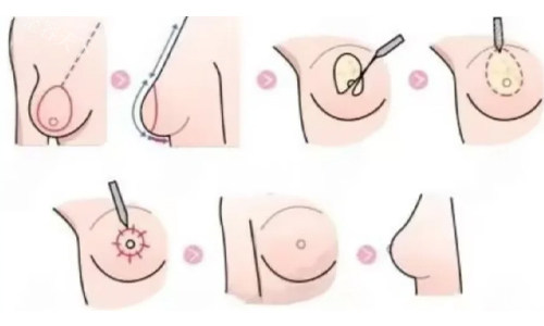 巨乳缩小手术前后对比：下垂、驼背问题均有改善,再也不用担心跑两步胸部炸纹了!