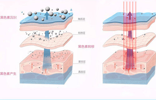 美白舱和光子嫩肤选哪个？两种方法适用于不同的部位和皮肤问题