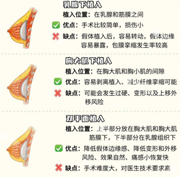 济南假体隆胸一般要多少钱？济南假体丰胸手术需要根据材质/品牌算价格，普通假体3万+！