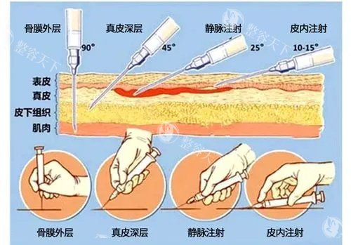 爱贝芙注射示意图 爱贝芙注射示意图