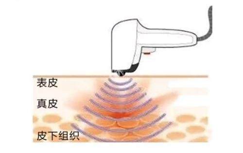 热拉提针对的皮肤层 热拉提针对的皮肤层