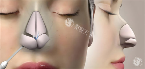 房志强医生的鼻综合手术真的靠谱吗？我的肋骨鼻经历告诉你：术后结果自然又精致​