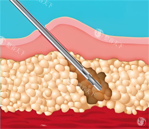 亳州缔莱美整形靠谱吗？吸脂/填充价格表+缔莱美超皮秒祛斑真实反馈!